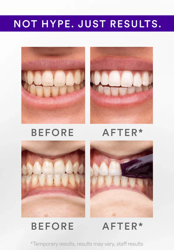 Last 3 Hours: 70% OFF🔥 -V34 Whitening Strips